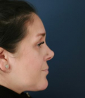 Feel Beautiful - Rhinoplasty Surgery - After Photo